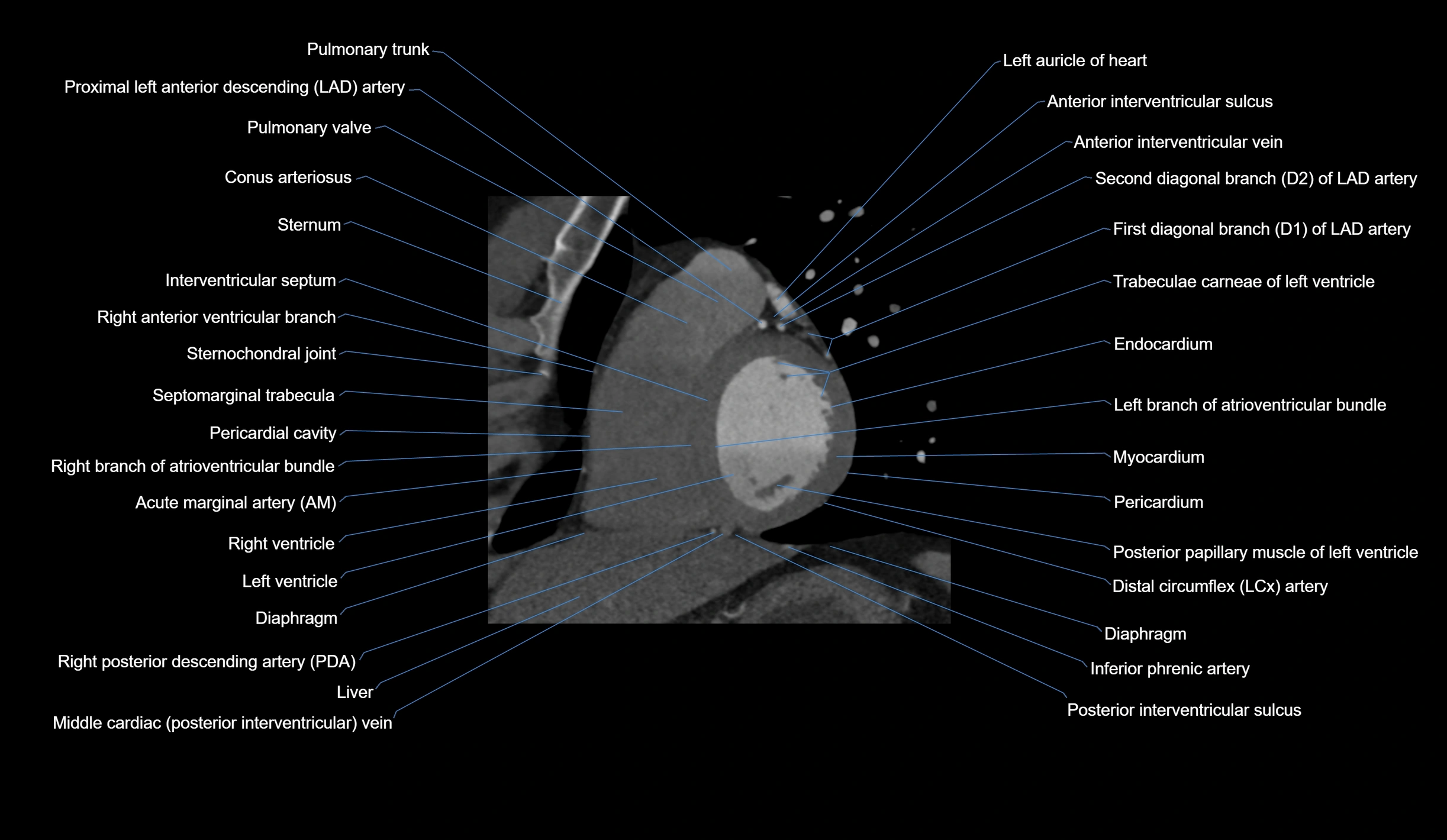 CT heart (coronary angiogram) short axis view  cross sectional anatomy labelled radiology image-00029.webp